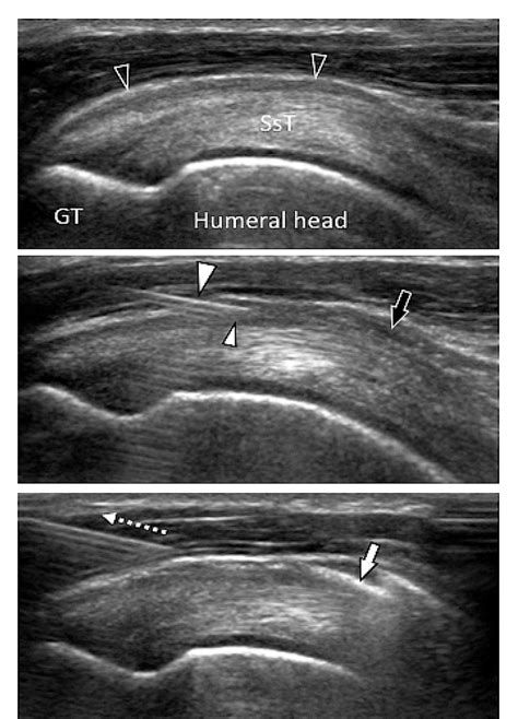 Figure 4 from US guided corticosteroid injection into the subacromial-subdeltoid bursa ...