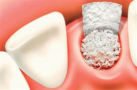 Bone Grafting for Dental Implants at Pacific Oral Surgery