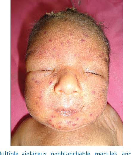 Congenital Rubella Syndrome Blueberry Muffin Rash