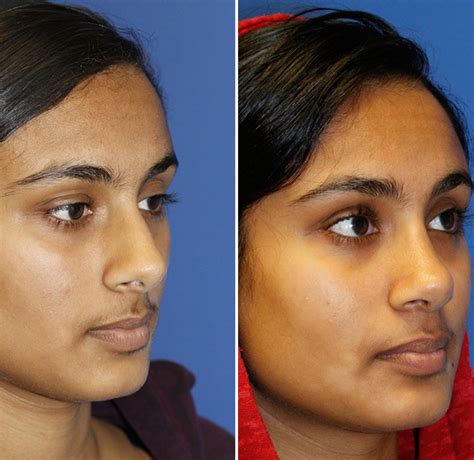 New Indian and Pakistani rhinoplasty page | Rhinoplasty in Seattle | Rhinoplasty Surgeon