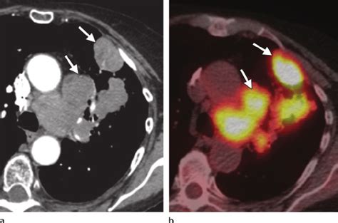 Pet Scan Images Lung Cancer