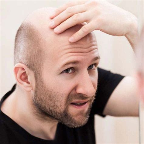 What is Male Patern Baldness? Causes, Cure & More | Man Matters