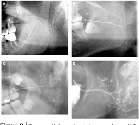 Figure 2 from Radiographic aspects of major salivary glands in ...