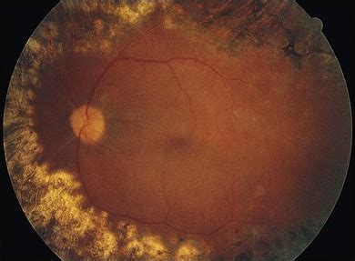 Surgery for Proliferative Diabetic Retinopathy | Ento Key