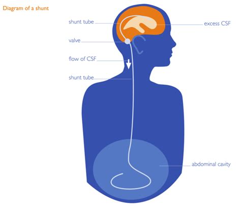 What is Hydrocephalus? – Spina Bifida and Hydrocephalus Association of Canada