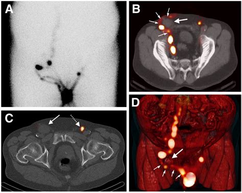 Pelvic Lymph Nodes Anatomy Ct Figure 13 Pelvic Lymph Nodes And | Images and Photos finder