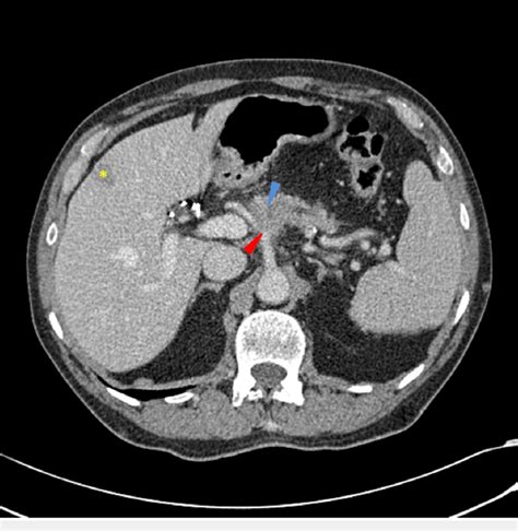 Ct Scan Abdomen Pelvis Anatomy