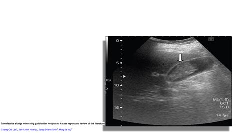 Gallbladder Ultrasound Sludge