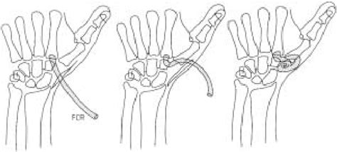 Figure 1 from Ligament reconstruction/tendon interposition arthroplasty for thumb basal joint ...