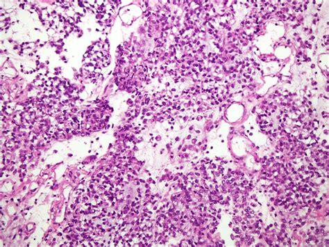 Stomach - Gastrointestinal stromal tumor (GIST)