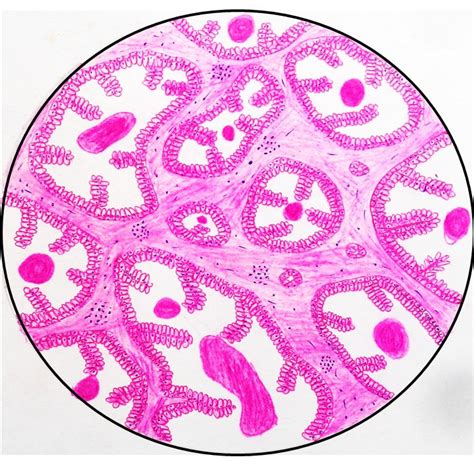 Benign Prostatic Hyperplasia (BPH) - Pathology Made Simple