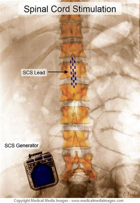 Spinal cord stimulator reviews - freeloadssterling