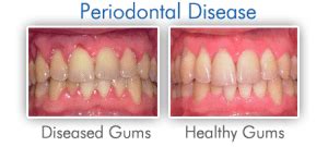 Gum Disease - Thornhill Dentist - North York Dentistry