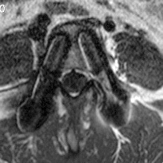 Susceptibility artifact - Questions and Answers in MRI