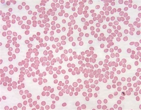 Immune Thrombocytopenic Purpura (ITP) – Stepwards