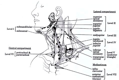 NECK DISSECTION | Dr John Chaplin Head and Neck Surgeon