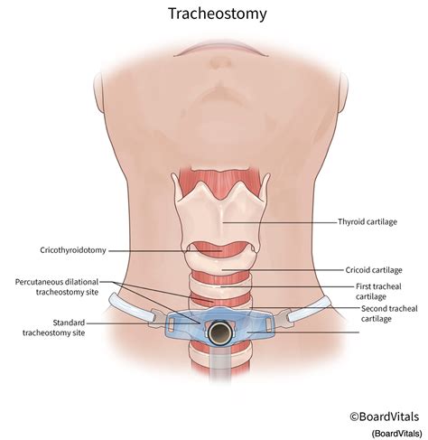 Tracheostomy Placement and Care Nursing CE Course | NursingCE