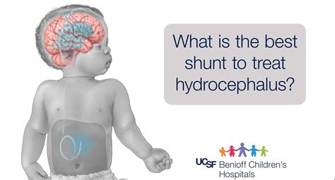 Hydrocephalus In Children