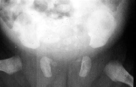 Spondyloepiphyseal dysplasia congenita - wikidoc