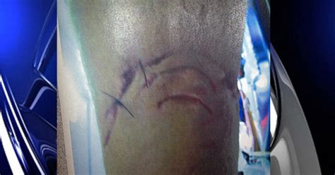 Man Bitten In Leg By Shark Or Barracuda Ready To Leave Hospital - CBS Miami