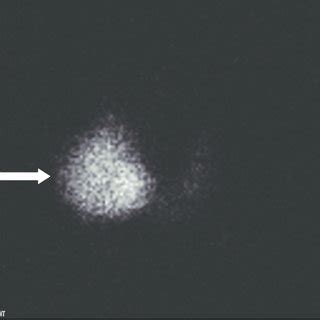 Transverse sonogram showing a large heterogeneous right thyroid nodule... | Download Scientific ...