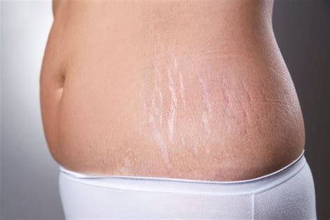 Ways to Reduce Stretch Marks after Weight Loss - Theayurveda