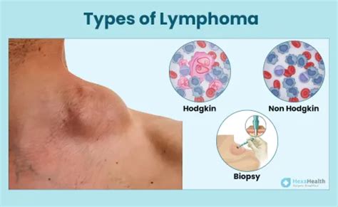 What are the Different Types of Lymphoma?