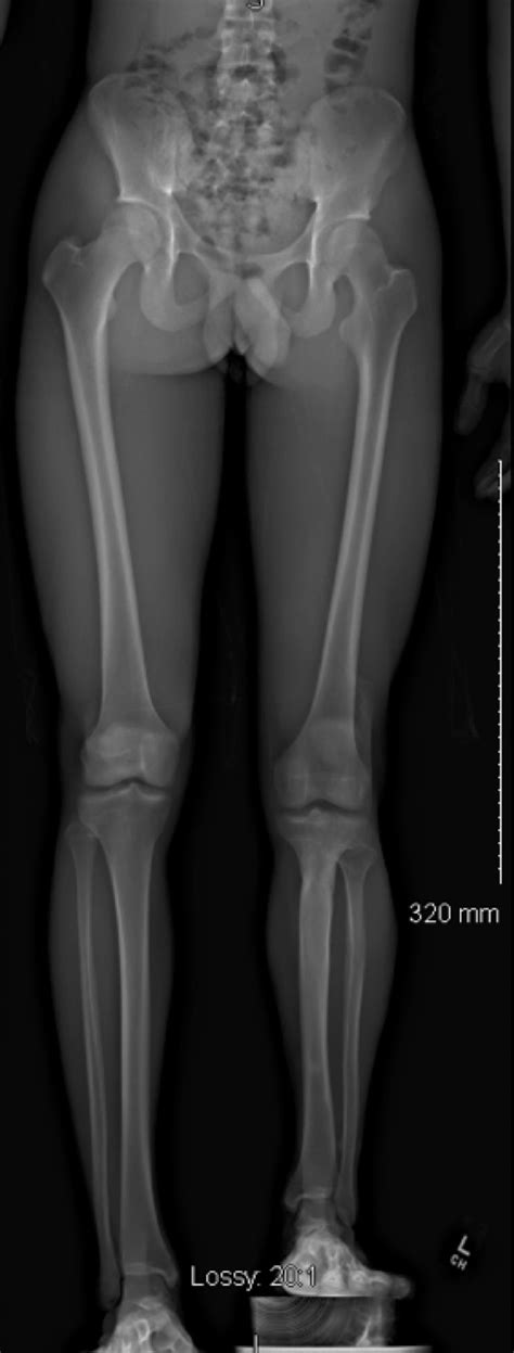 OrthoKids - Leg Length Discrepancy