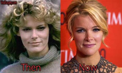 Megyn Kelly Plastic Surgery, Before and After Botox Pictures