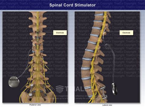 Spinal Cord Stimulator - TrialExhibits Inc.