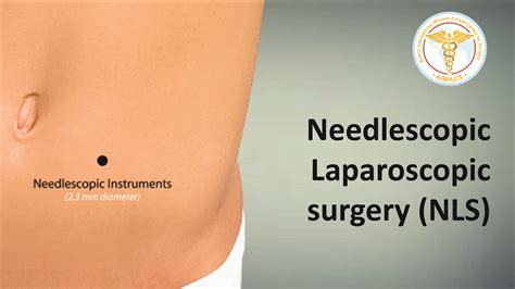 Recovery after Laparoscopic Nissen’s Fundoplication. What to expect? – MSL Hiatus Hernia Surgery