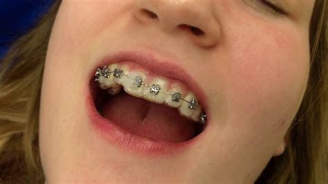 How to: Temporarily Fix a Broken Bracket on Your Braces - Banasiak ...