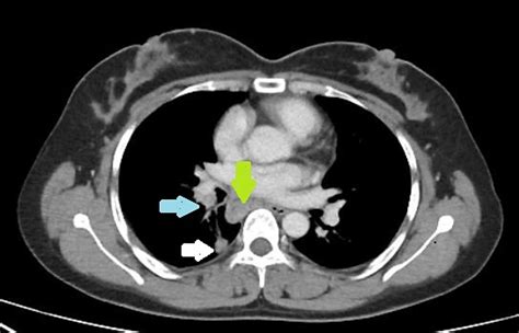 Cureus | The Clinicopathological Features of Mediastinal Tuberculous Lymphadenitis in Cancer ...