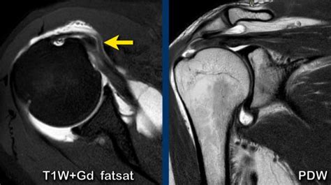 The Radiology Assistant : Shoulder - Rotator cuff injury