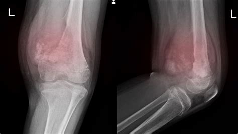 Soft Tissue Sarcoma: Symptoms and Causes