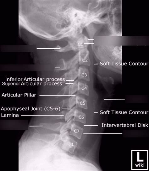 LAT Soft Tissue Neck X-Ray Anatomy Diagram | Quizlet