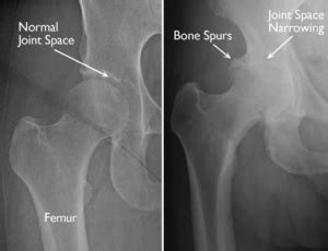 Causes of Hip Arthritis | David Slattery