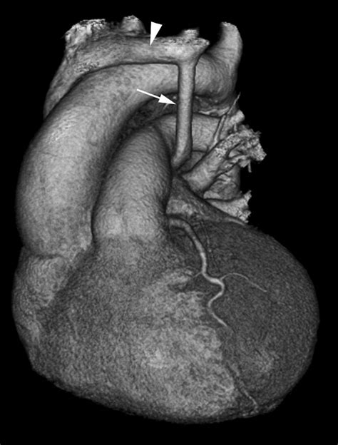 A rare case of left superior vena cava draining into left atrium demonstrated by MDCT ...