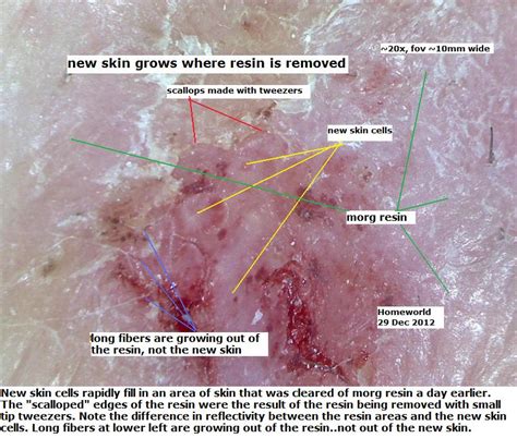 Morgellons Disease