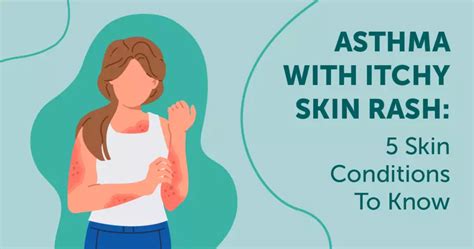 Asthma With Itchy Skin Rash: 5 Skin Conditions To Know | MyAsthmaTeam