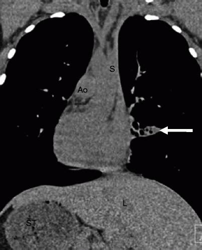 Heterotaxy Syndrome | Radiology Key