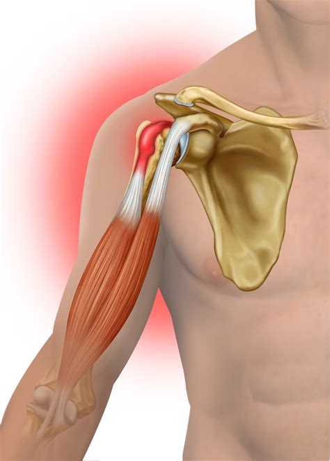 Biceps Tendinitis: Causes and Risk Factors