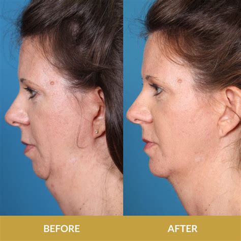 Before & After Chin Implants Results