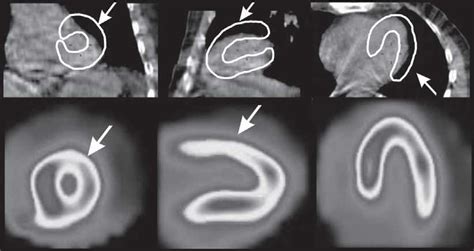 Example of an artifact caused by misalignment between SPECT and CT ...