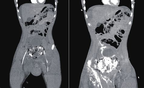 Ct Thorax Abdomen Pelvis With Contrast Scan