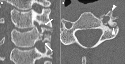 Undisplaced comminuted fracture of the C4 lateral mass (arrow), with ...