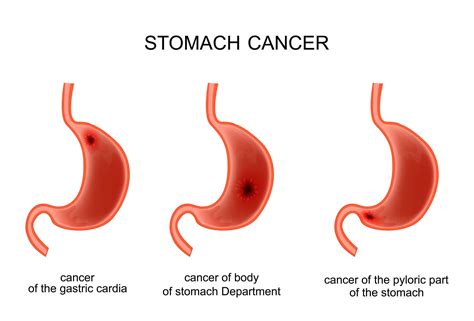 gastric-cancer5