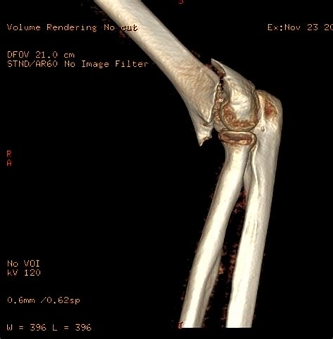 Distal humerus fracture - wikidoc