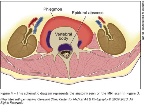 Spinal Epidural Abscess in a Heroin User | Consultant360