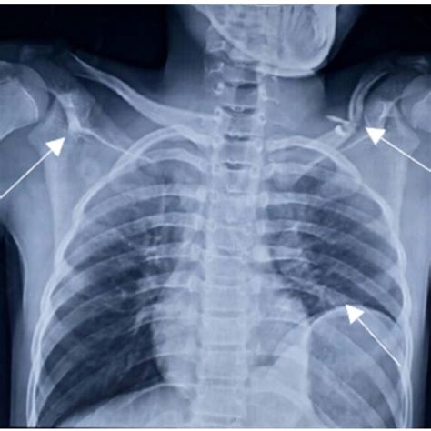 X-ray pelvis (Pre op); X-ray pelvis; AP showing bilateral pelvic bone ...